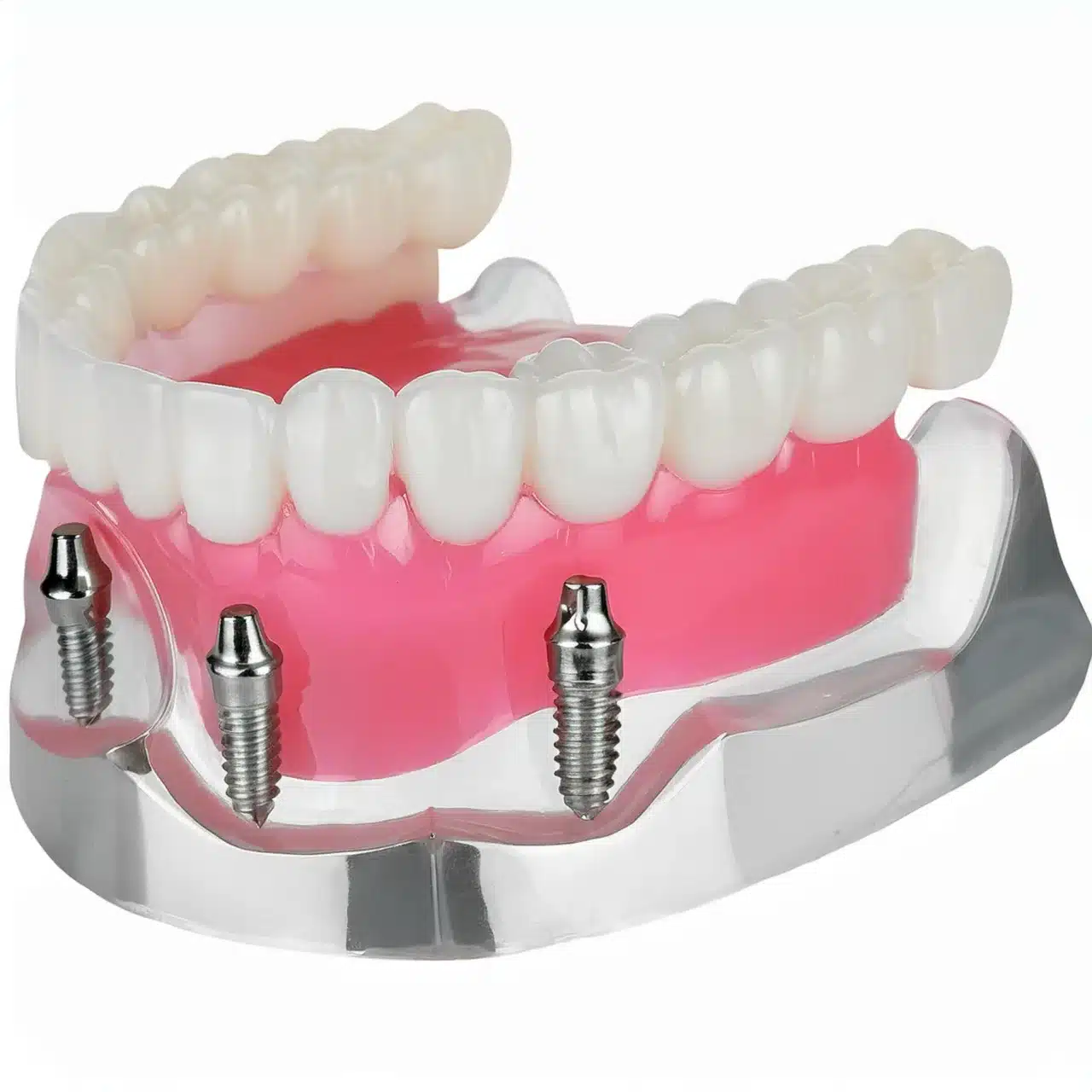 All on 4 dental implants ,3D plan