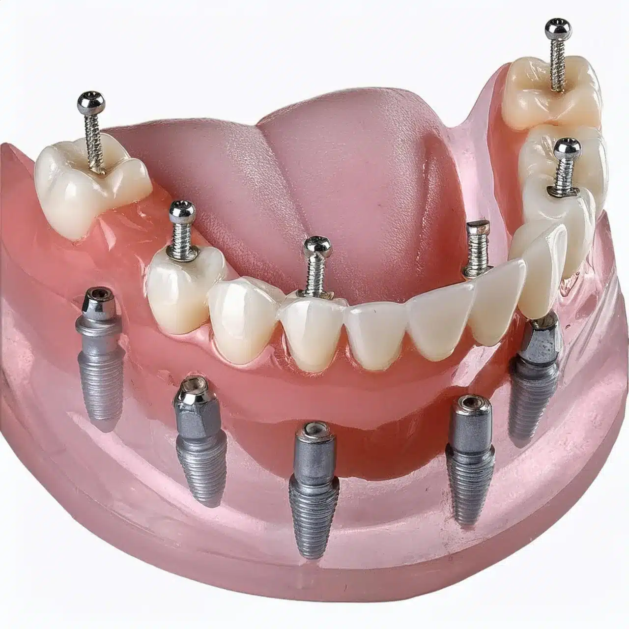 3D plan of All on 6 placement