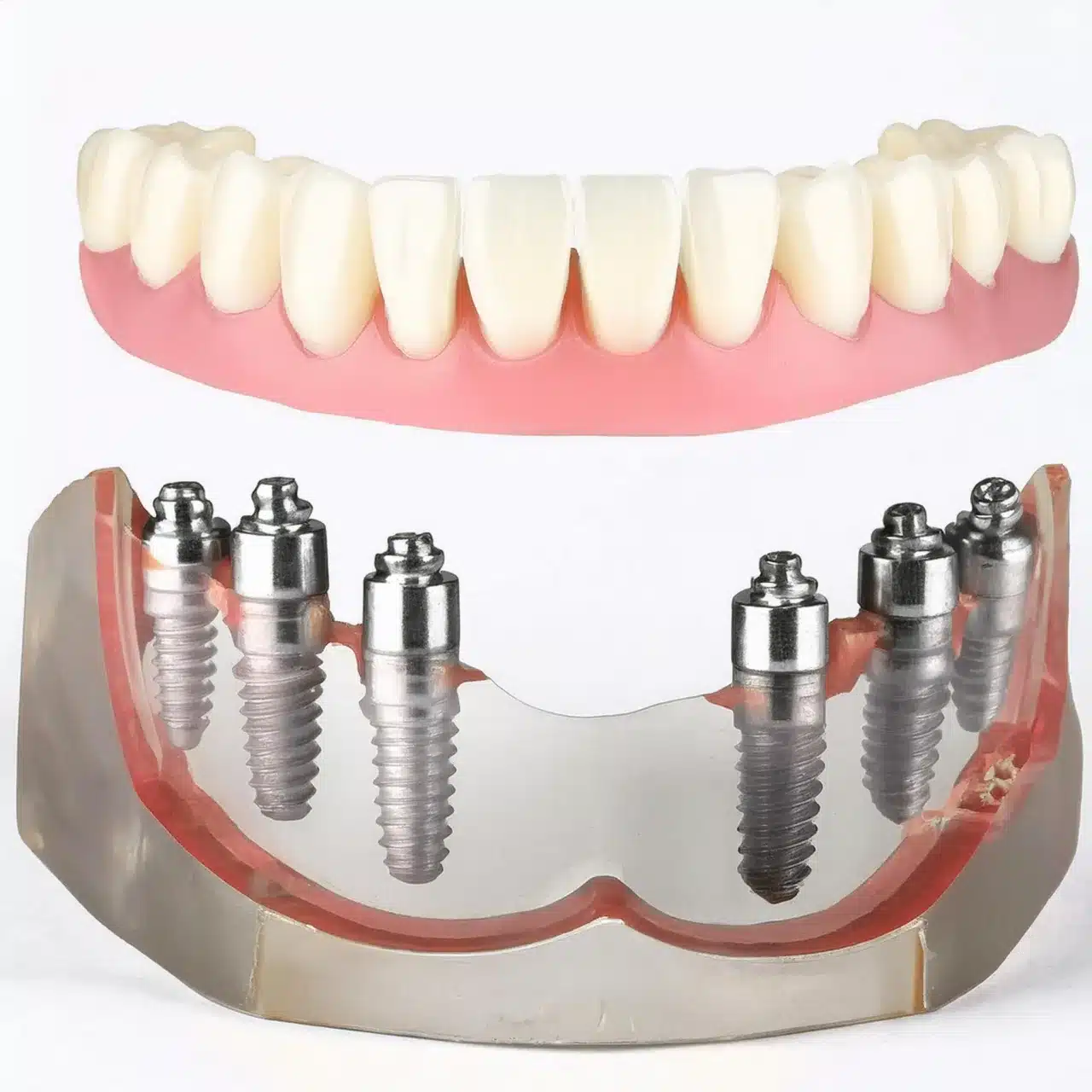 Tutti su 6 impianti dentali