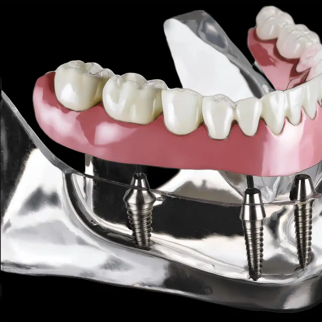 Piano 3D di tutti i 4 impianti dentali