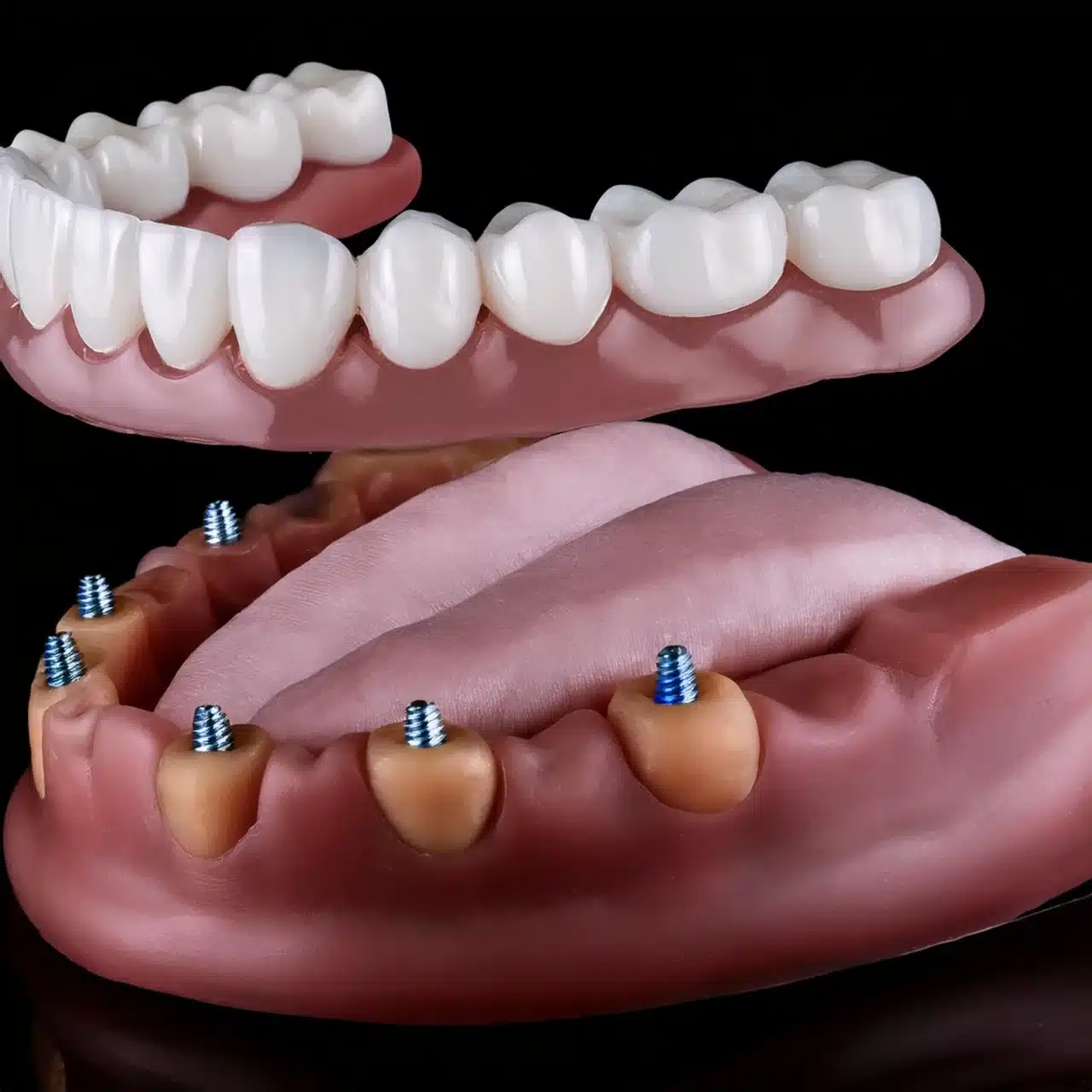 An example of all on 6 dental implants