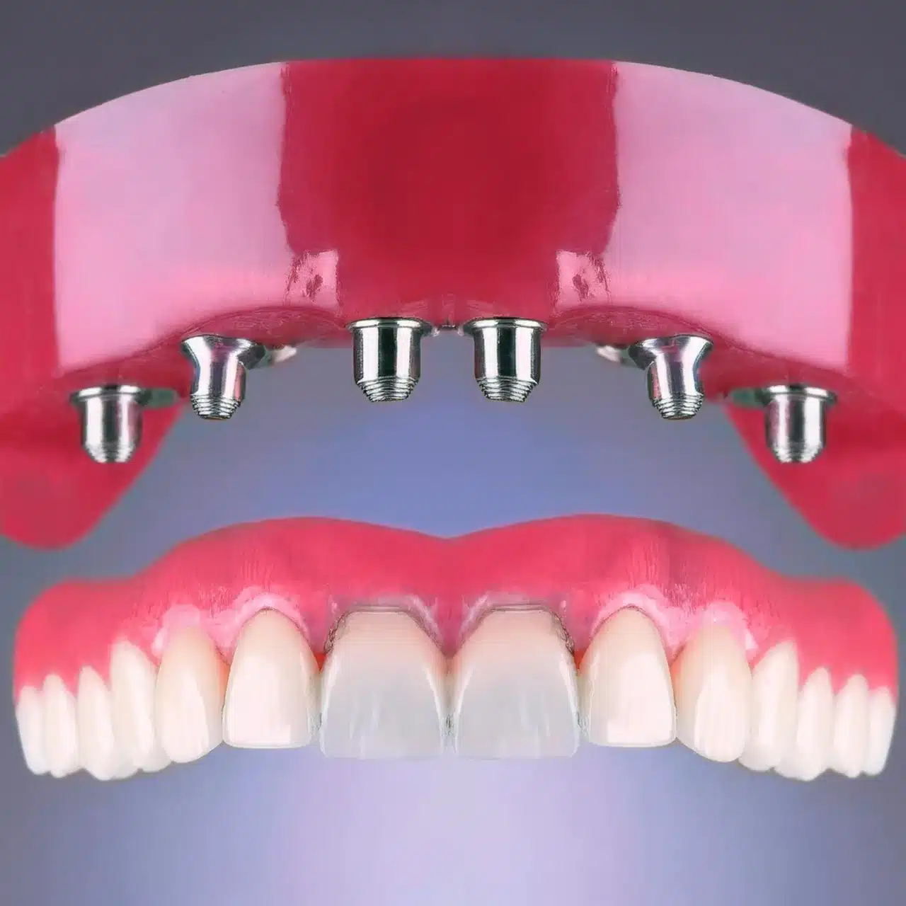 All on 6 dental implant process