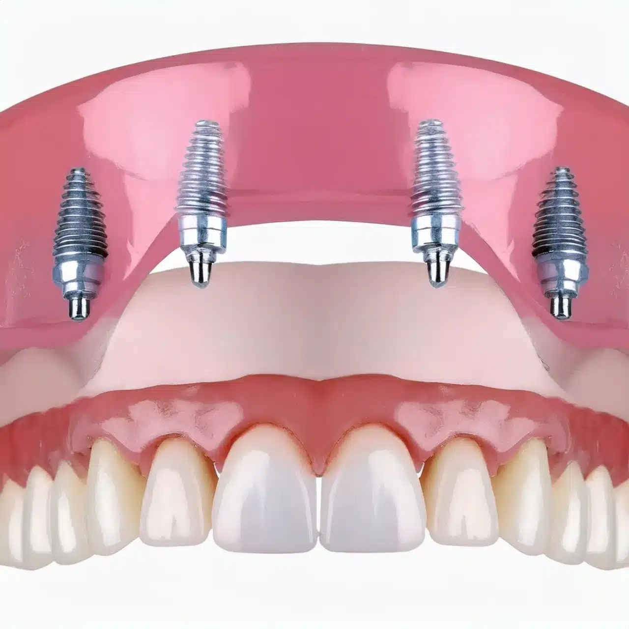 Piano 3D di tutti i 4 impianti dentali