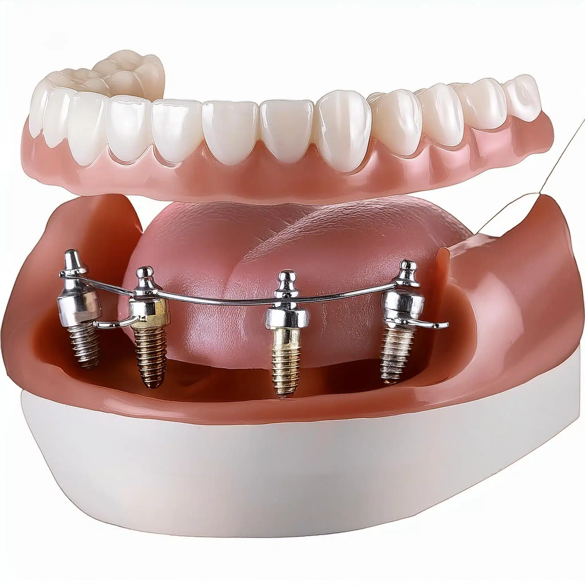 Implantes dentales All-on-4: Ventajas e inconvenientes