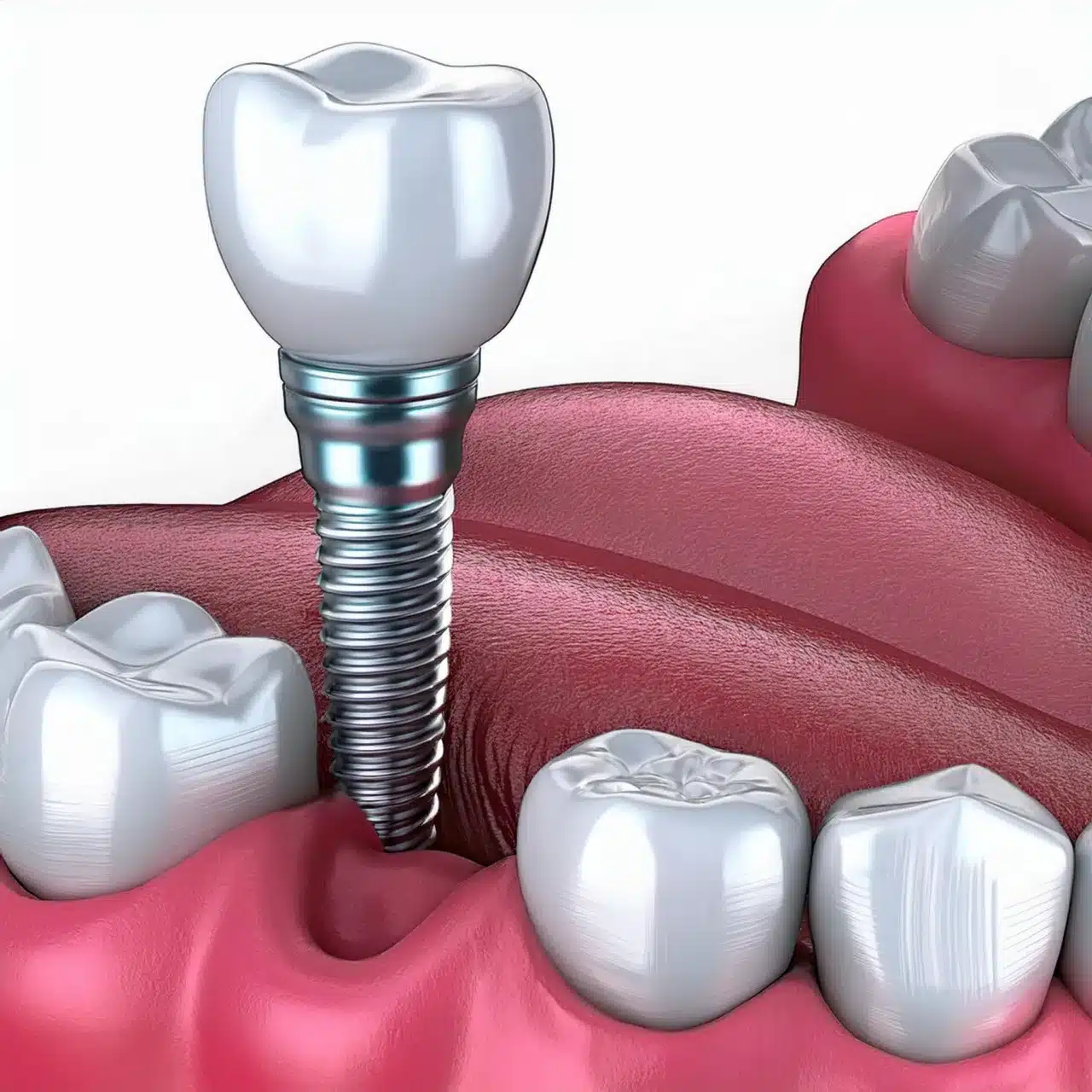 Alternative agli impianti dentali All on 6