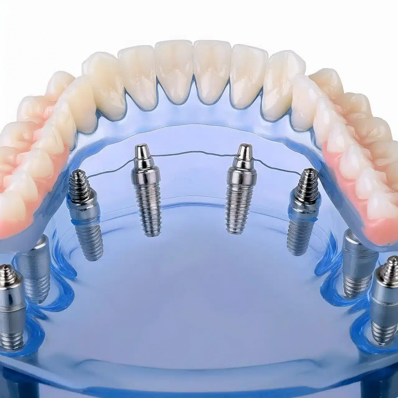 All-on-8 dental implants