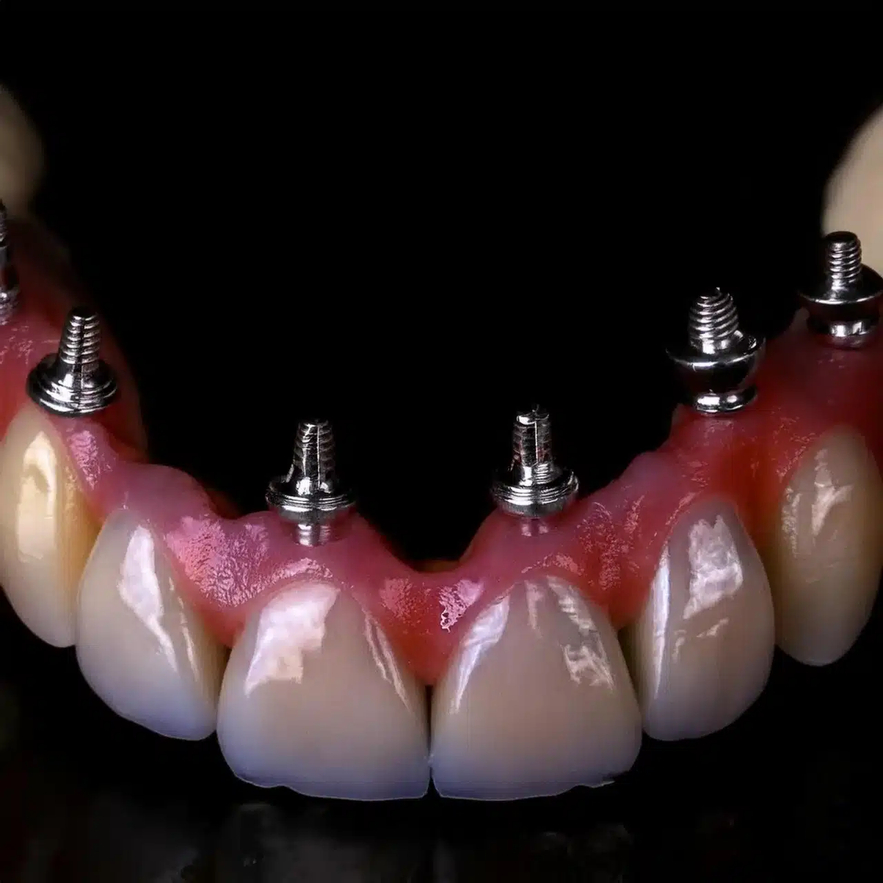 Quanto durano gli impianti dentali All-on-8?