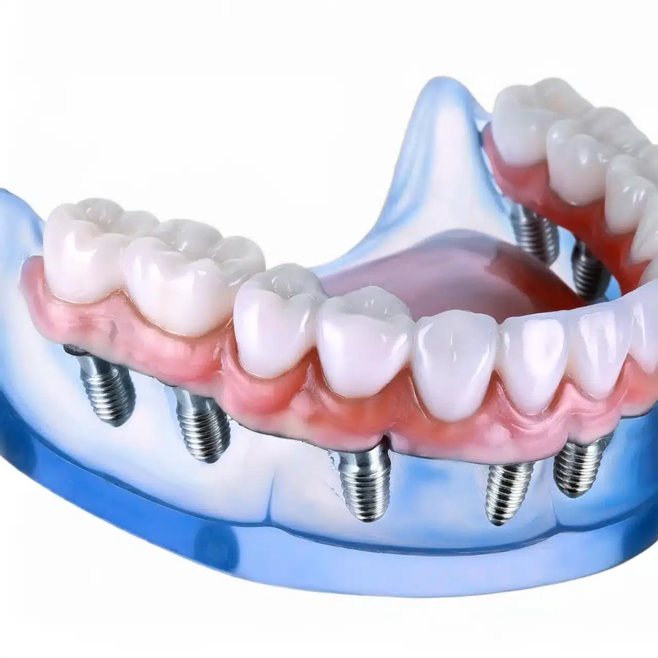 All-on-8 dental implants