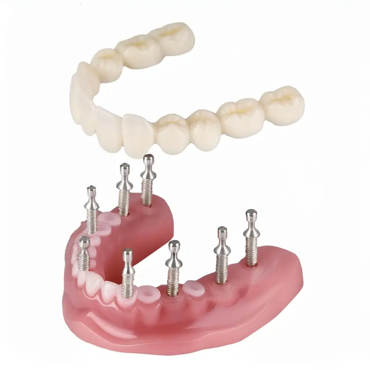 How is all-on-8 dental implants added?