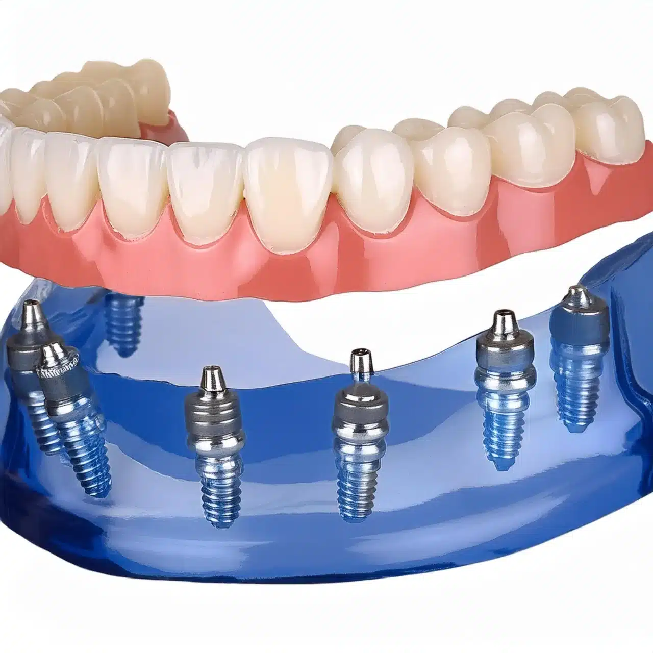 Example of All-on-8 dental implants