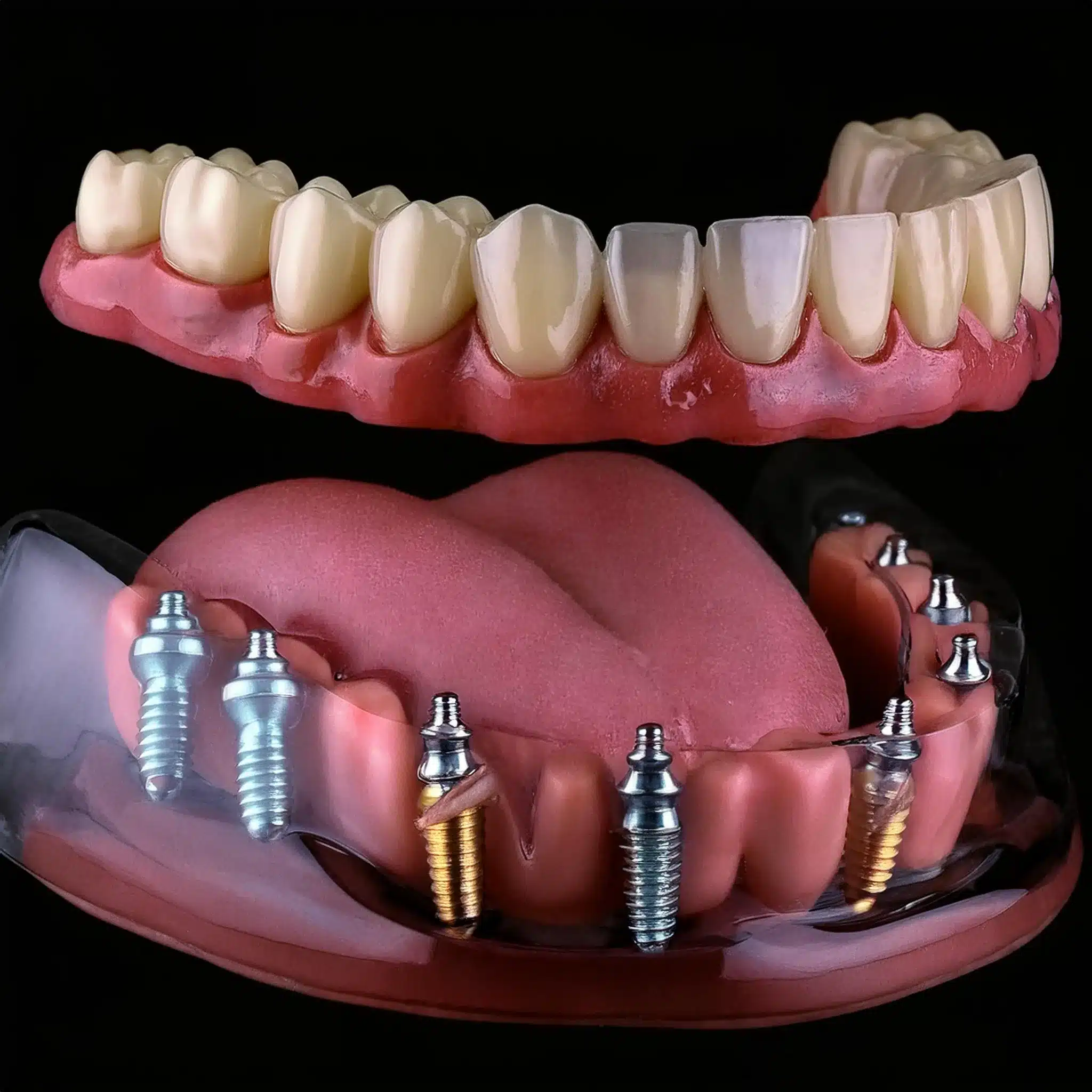 Firefly Generate a realistic and 3D photo of all on 8 dental implants. 81826