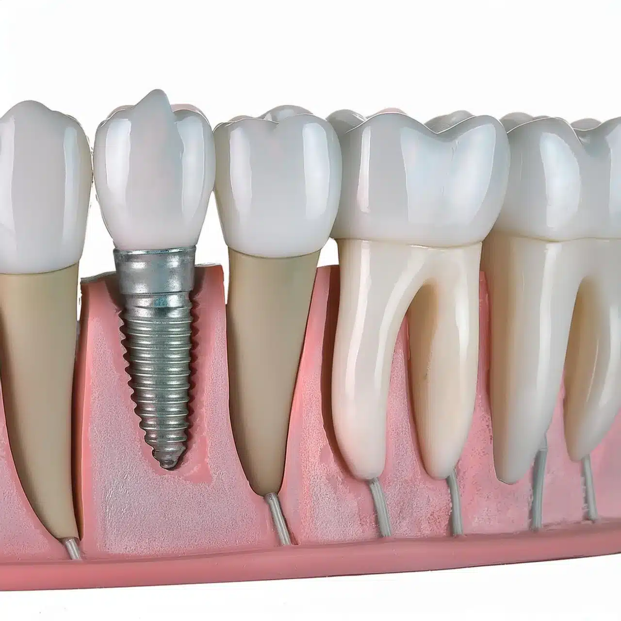 Example of all-on-8 dental implants