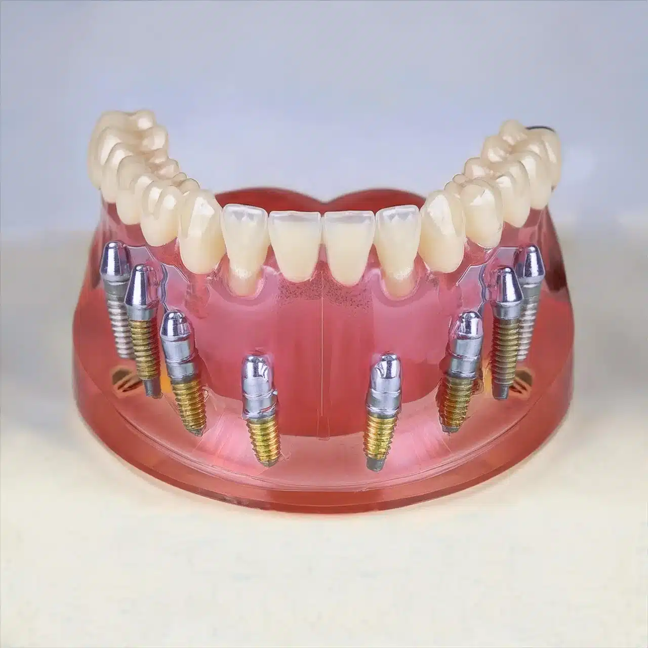 3D plan of all-on-8 dental implants