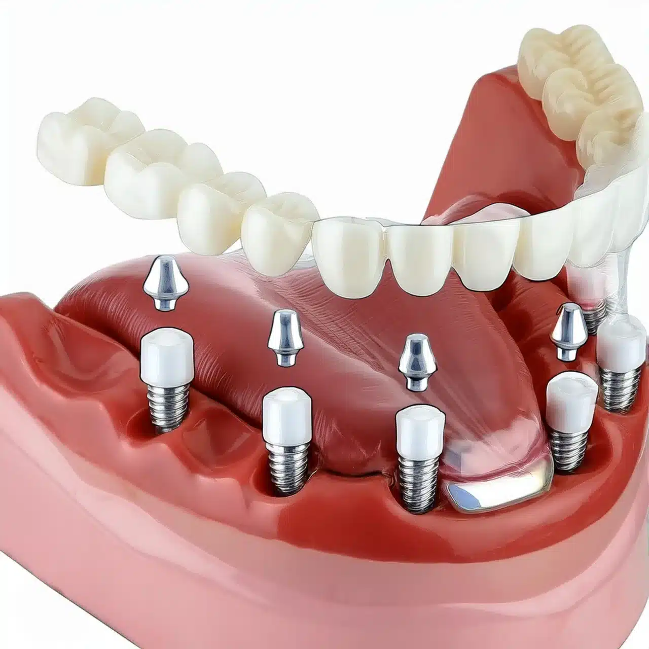 Tutti su 6 impianti dentali