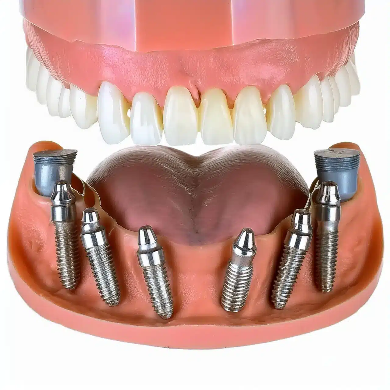 Piano 3D di tutti i 6 impianti dentali