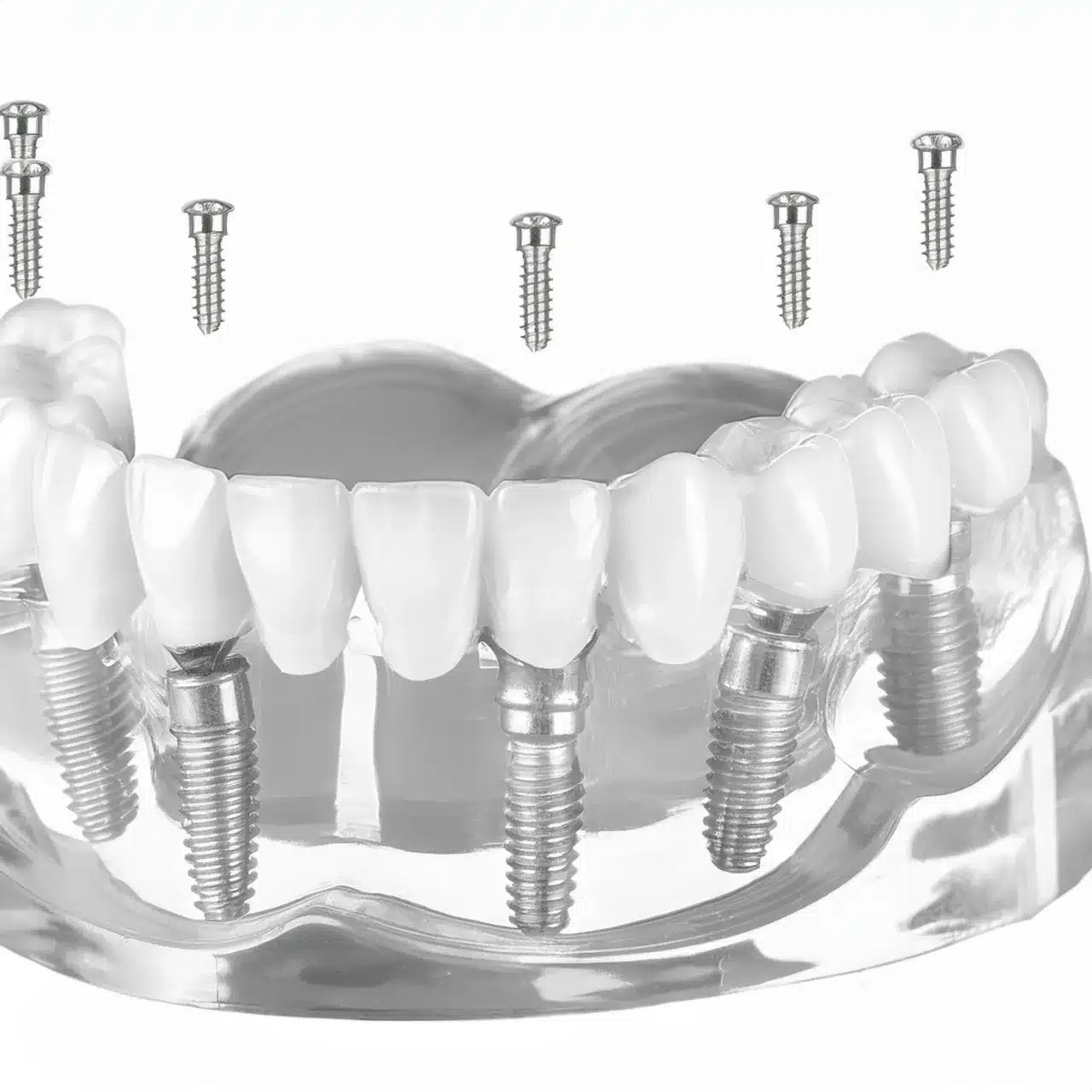 All on 6 dental implants technology