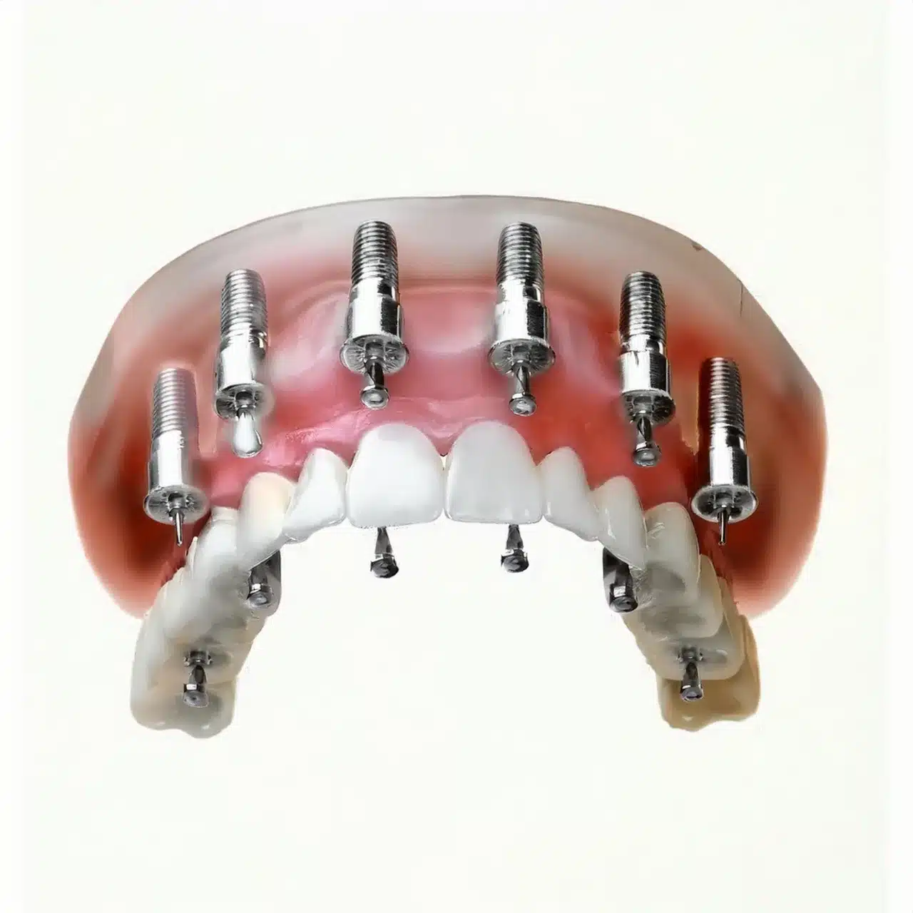 Acrylic all on 6 dental implants