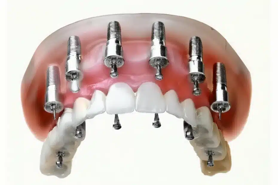 Firefly Generate a realistic and 3D photo of titanium all on 6 dental implants. 40971 1