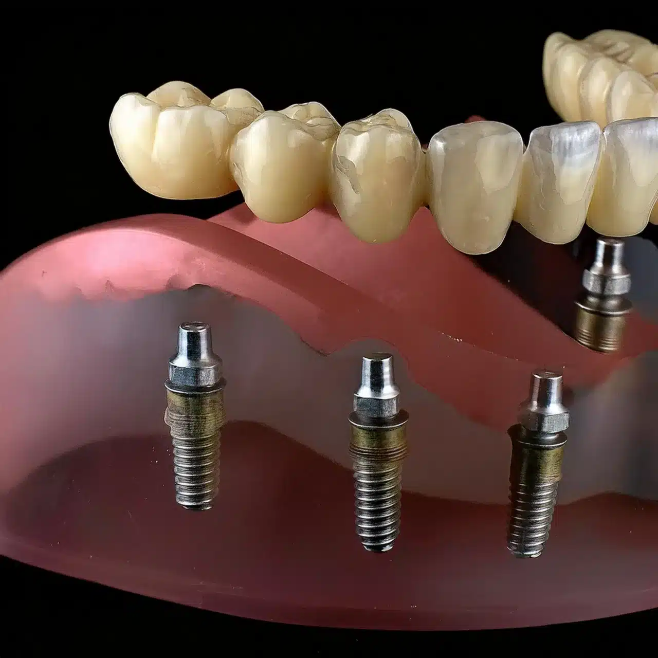 is all on 6 dental implants added?