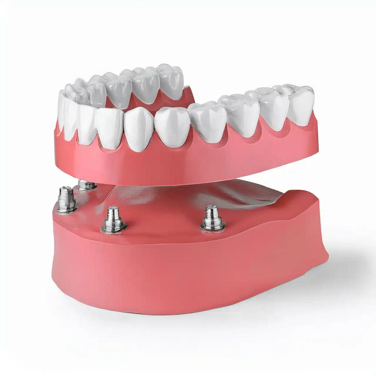 Impianti dentali All-on-4