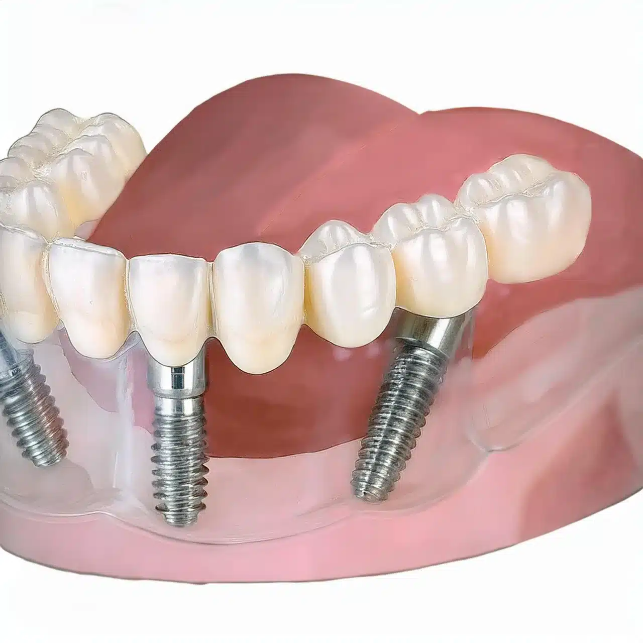 All-on-4 implants care