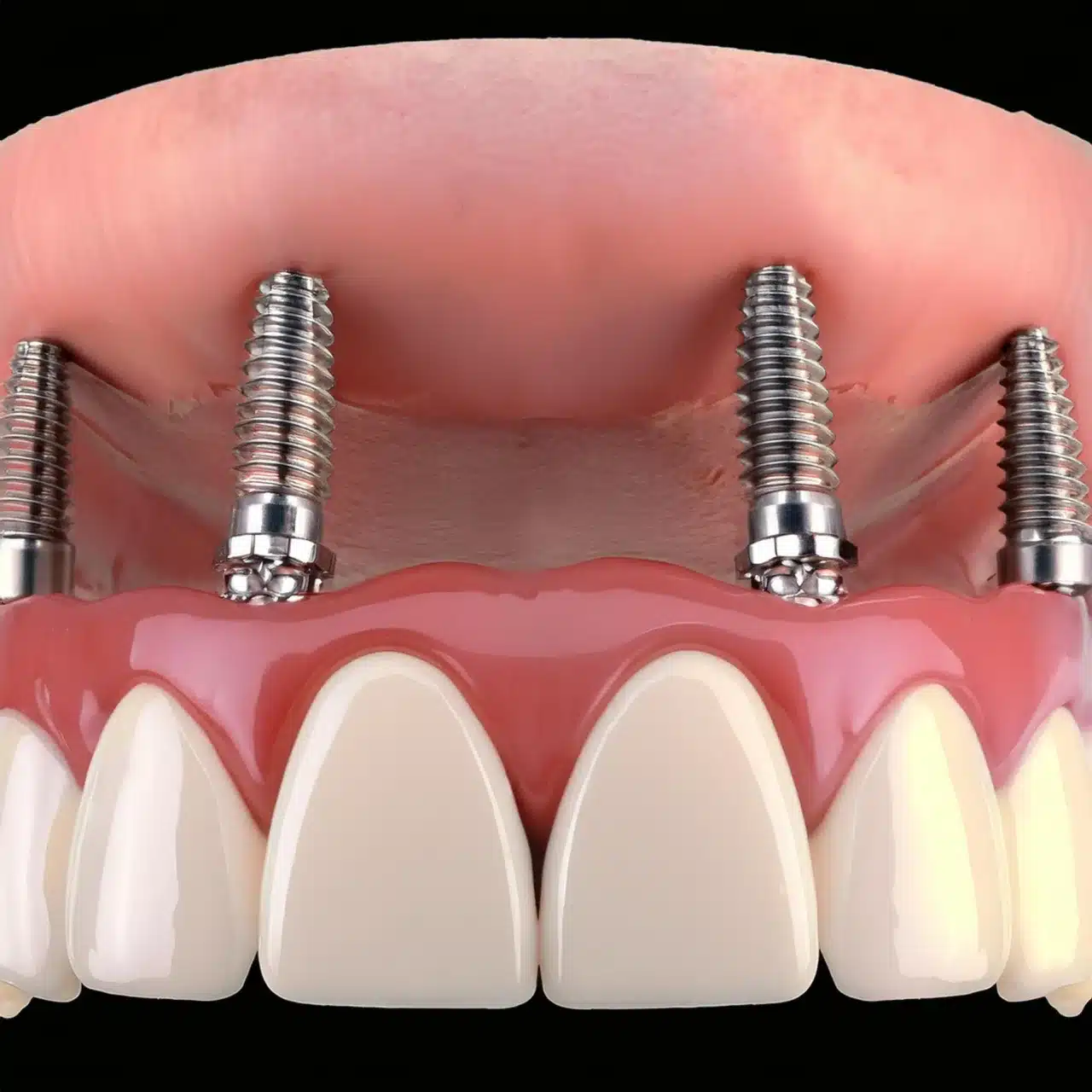 Example of All on 6 implants