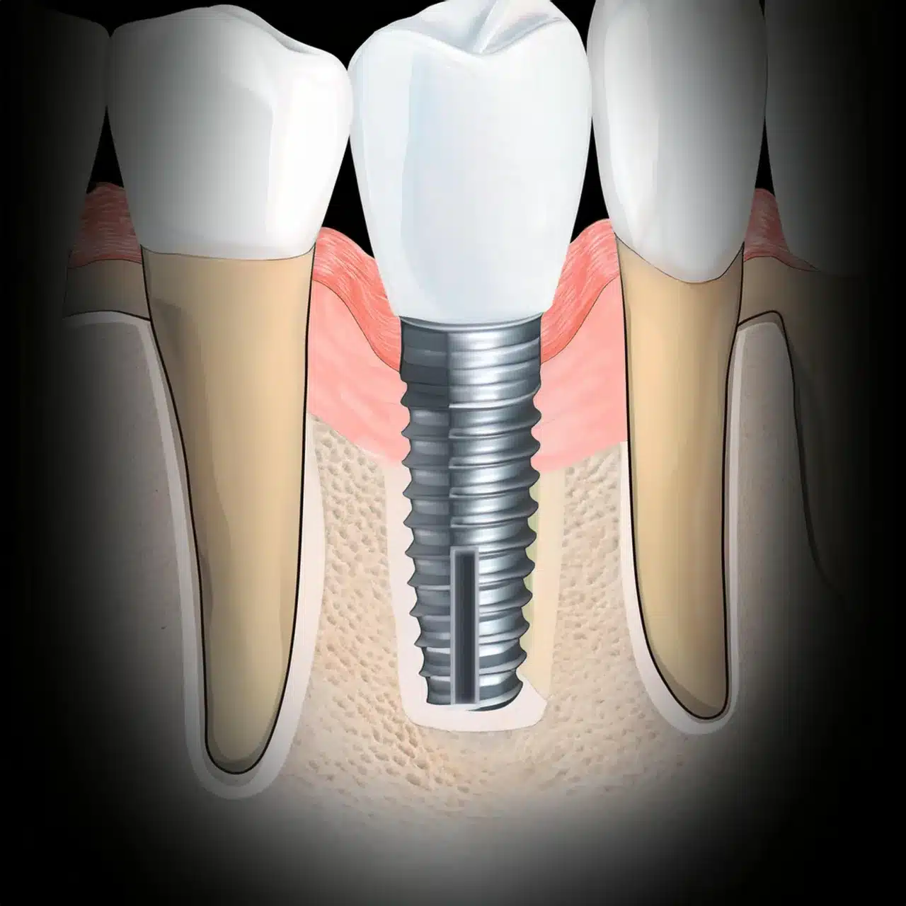 All on 6 dental implants placement