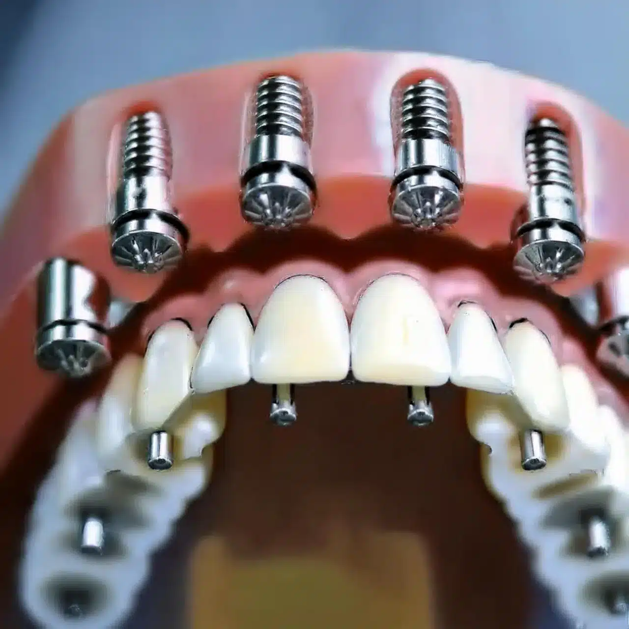 All on 6 dental implants placement