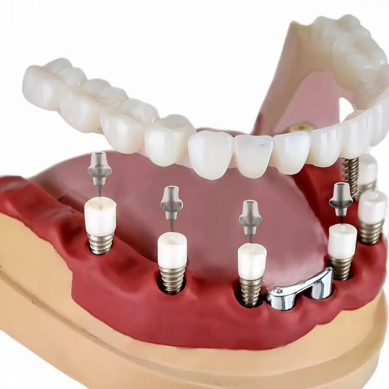 Proper care for all on 6 dental implants