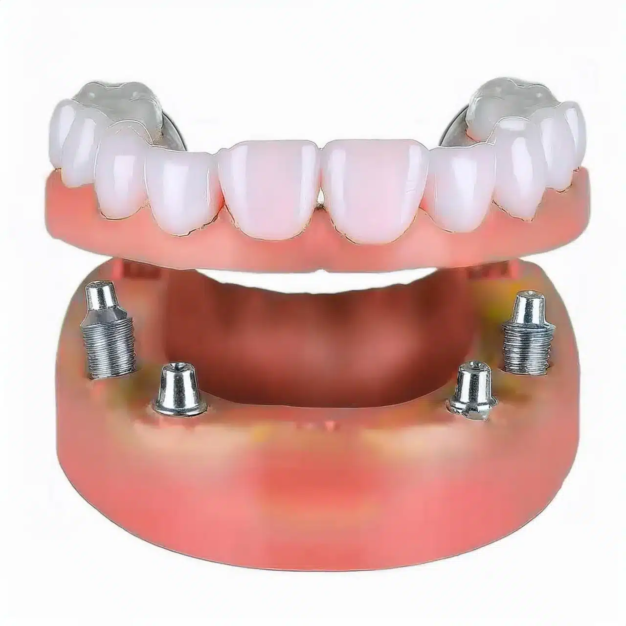 Example of all on 6 implant