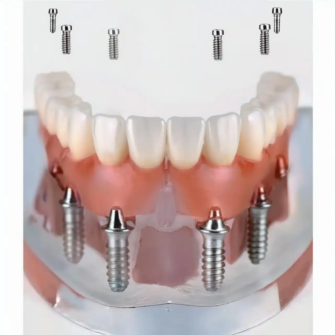 Example of all on 6 dental implants