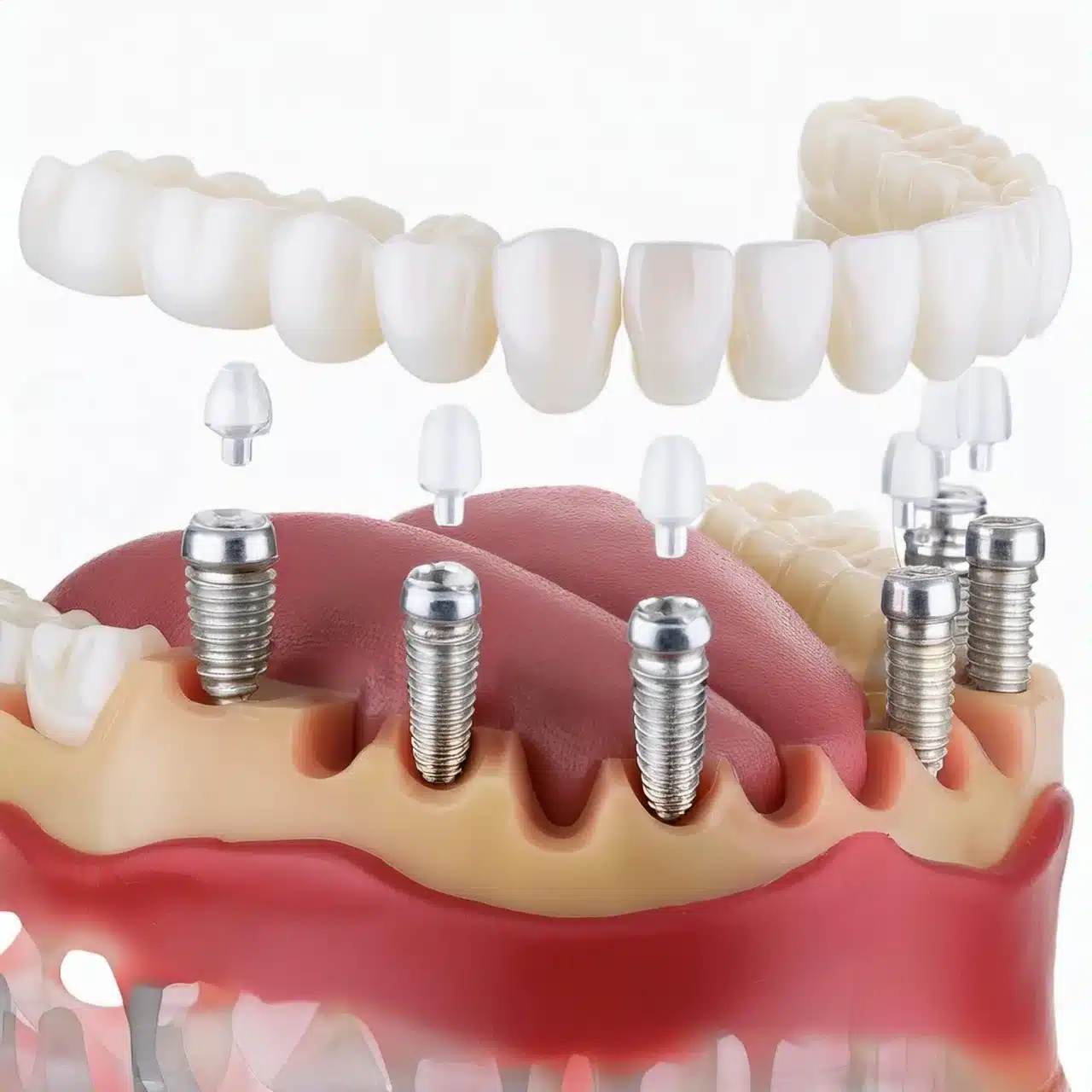 Tutti su 6 impianti dentali