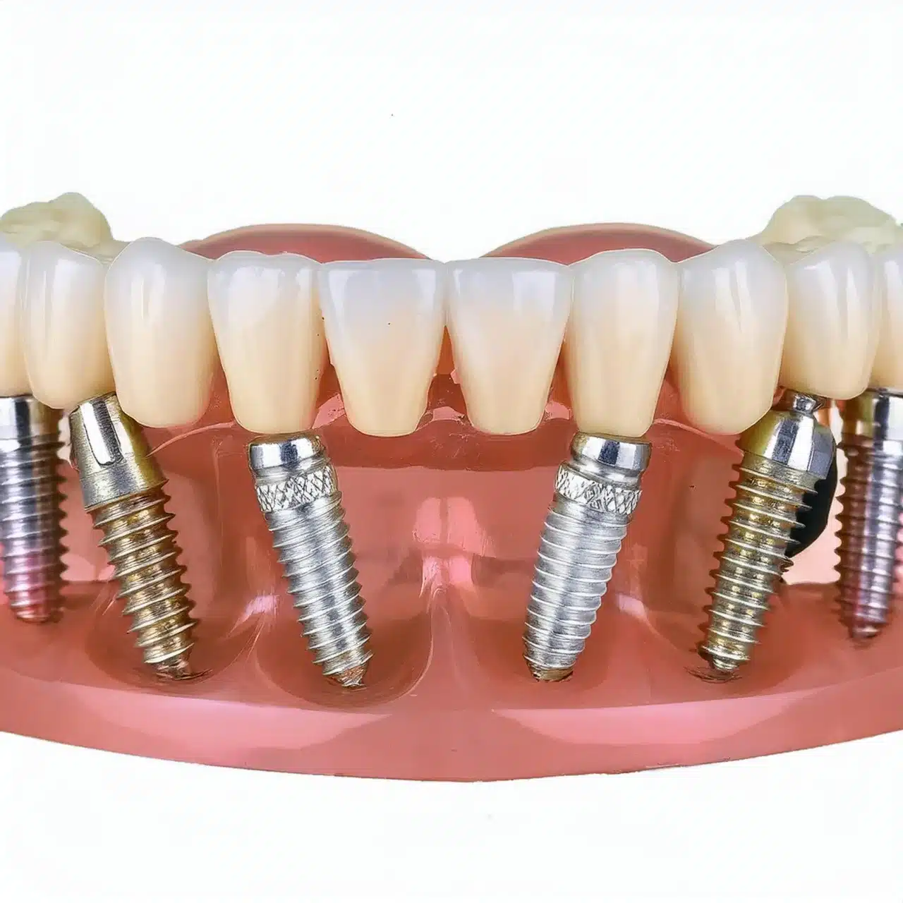 3D plan of all on 6 implants