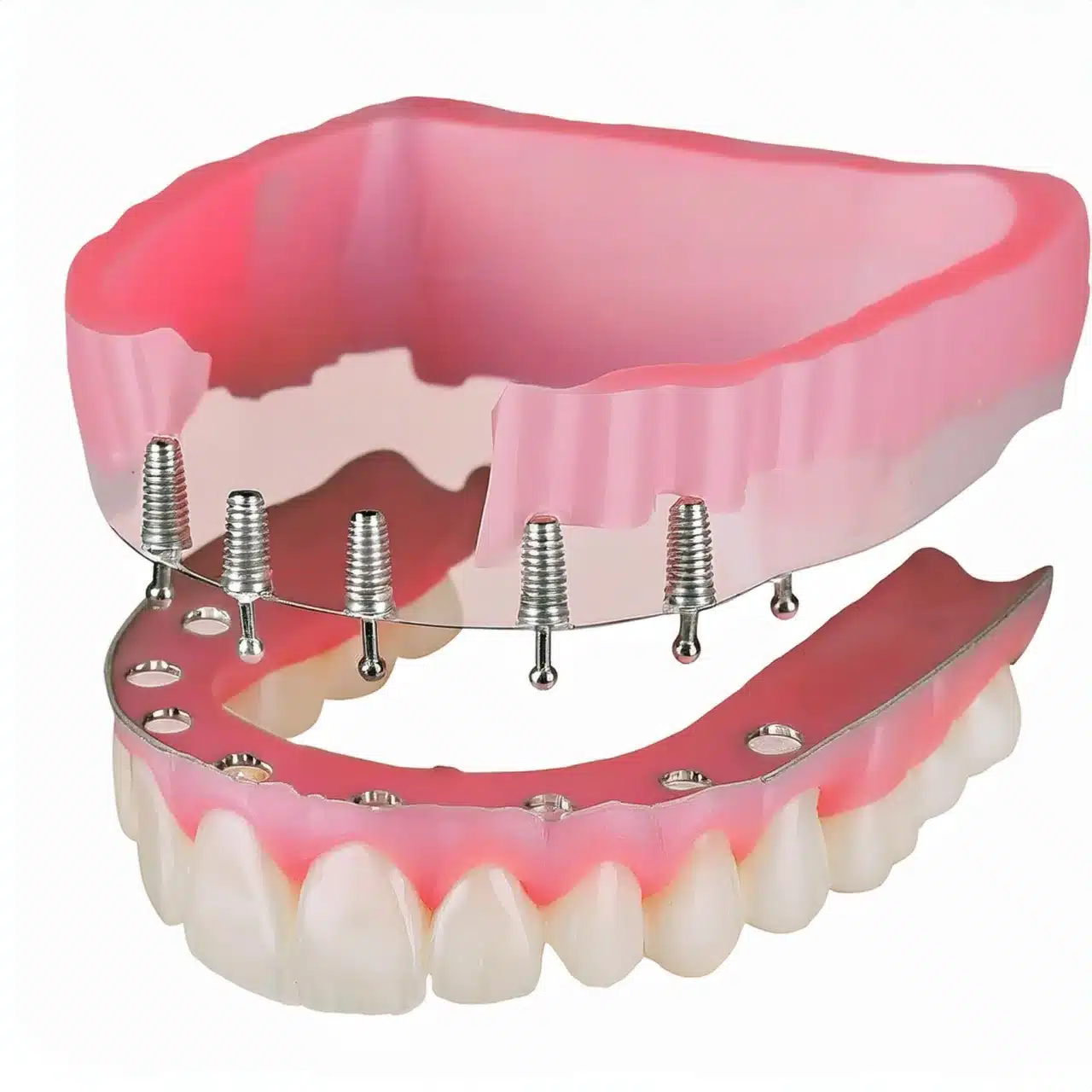 3D plan of all-on-8 dental implants