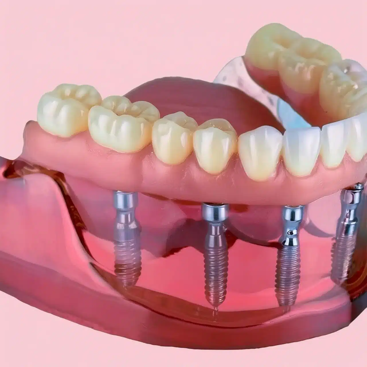 All-on-8 dental implants