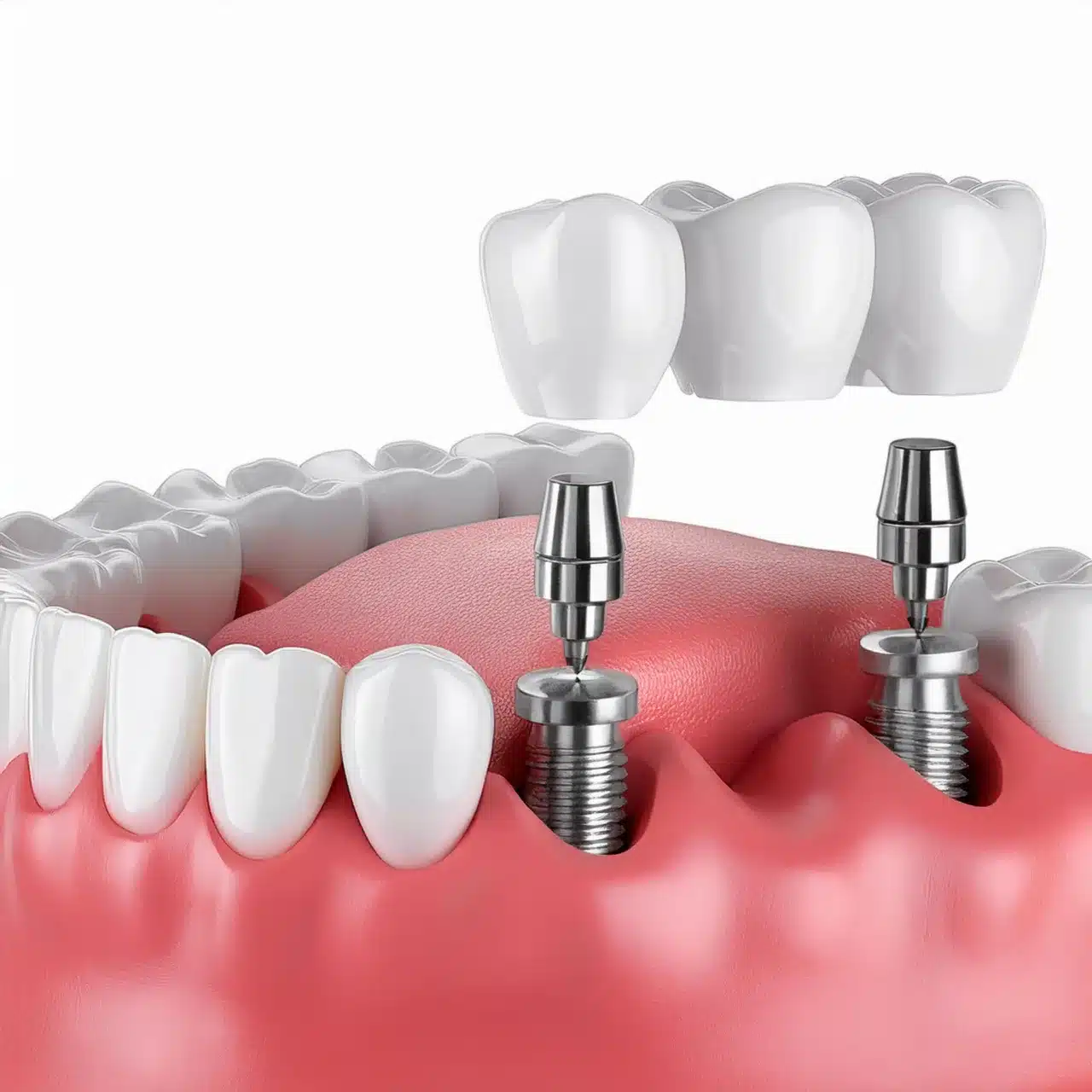 Ventajas e inconvenientes de los implantes dentales All-on-8