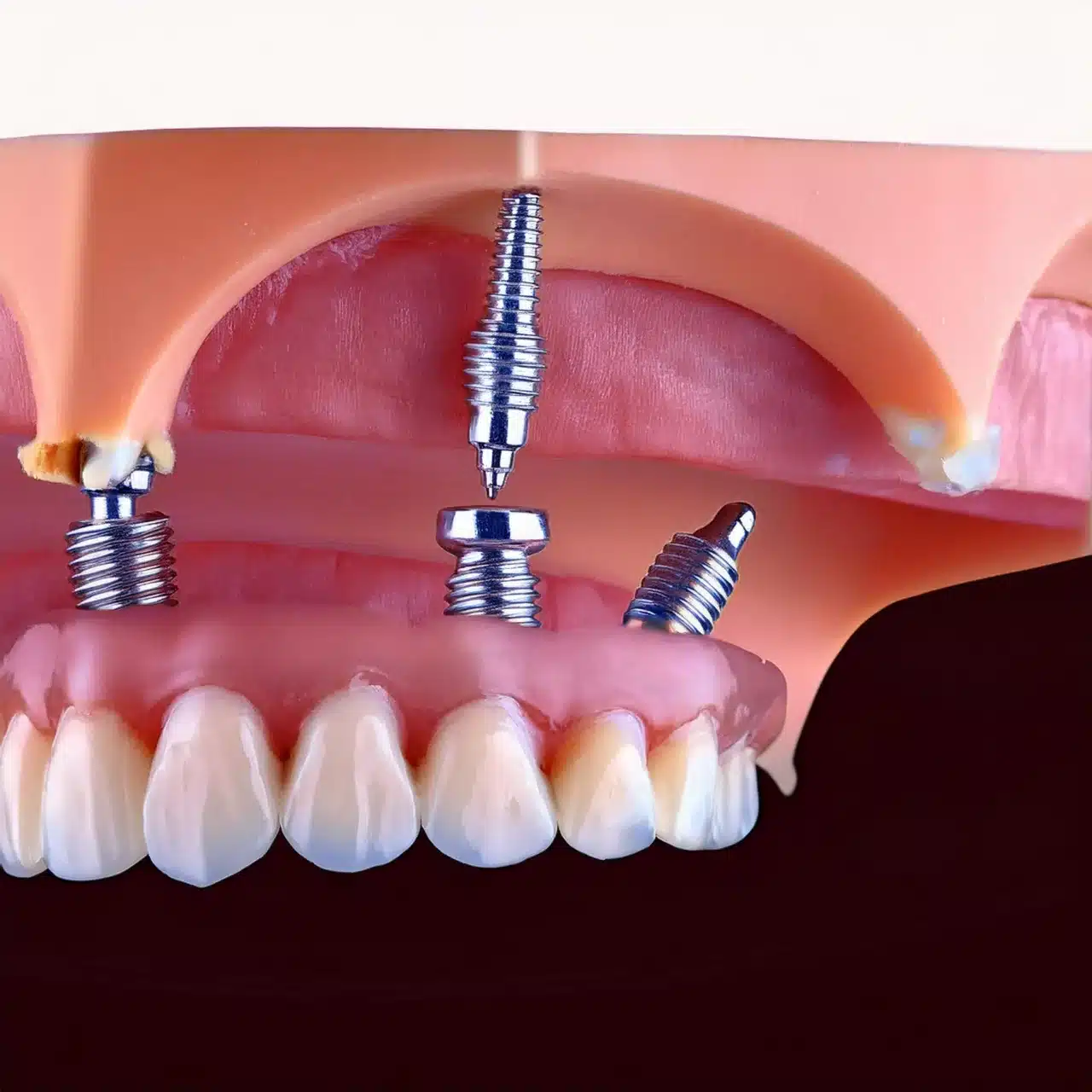 Price of all on 4 dental implants