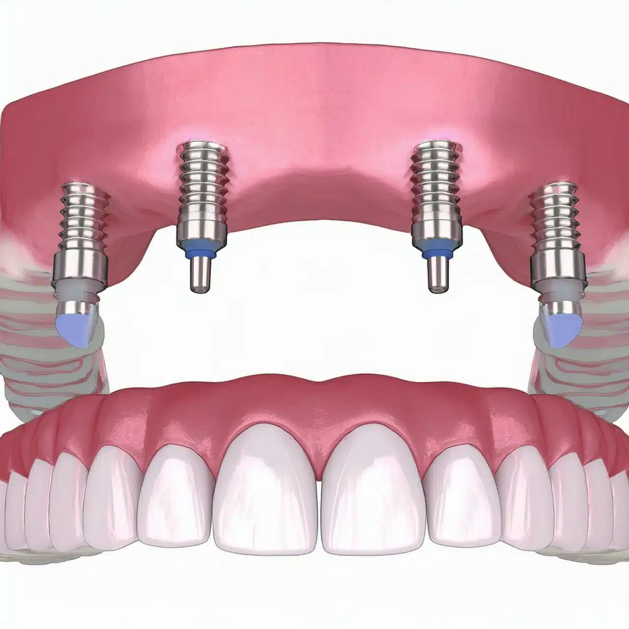 Tous sur 4 implants