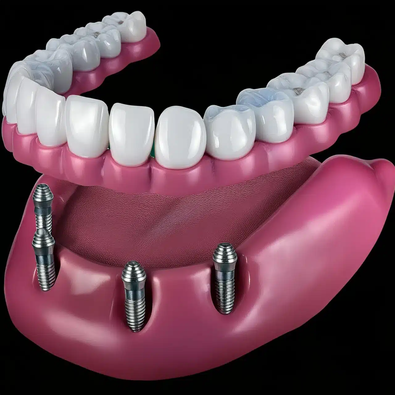 Plano 3D de los 4 implantes