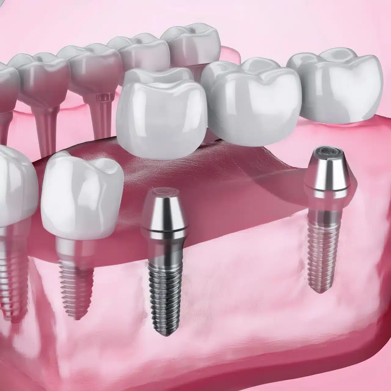 Procedimiento de implantes dentales All on 4