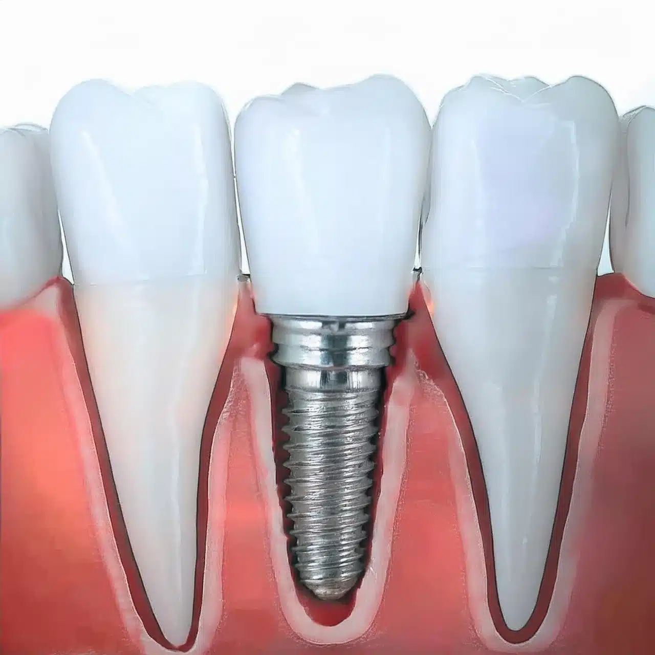 All on 4 implant placement