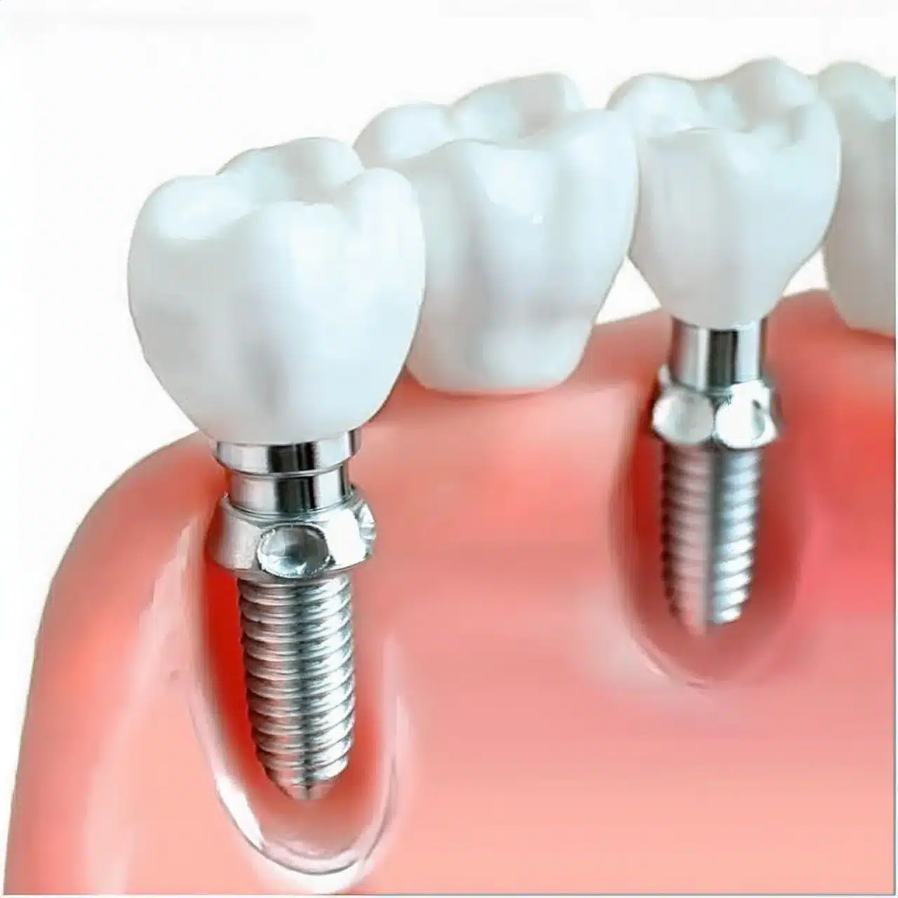 Të gjitha në 4 implante dentare