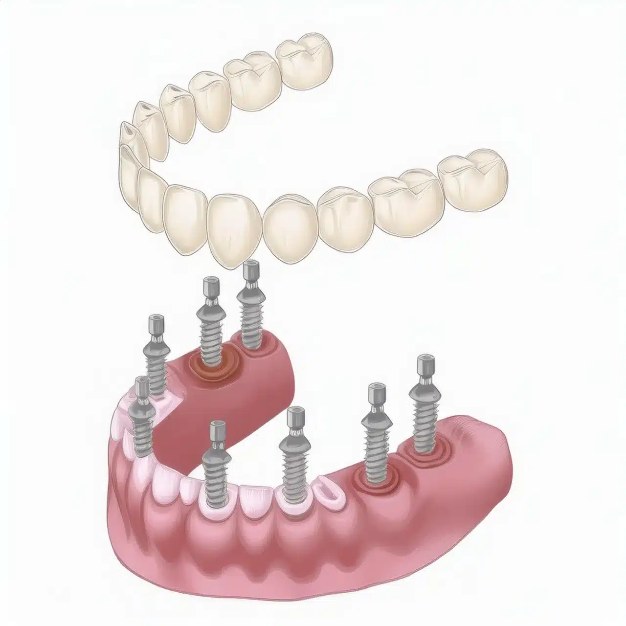 Mantenimiento de implantes dentales All-on-8