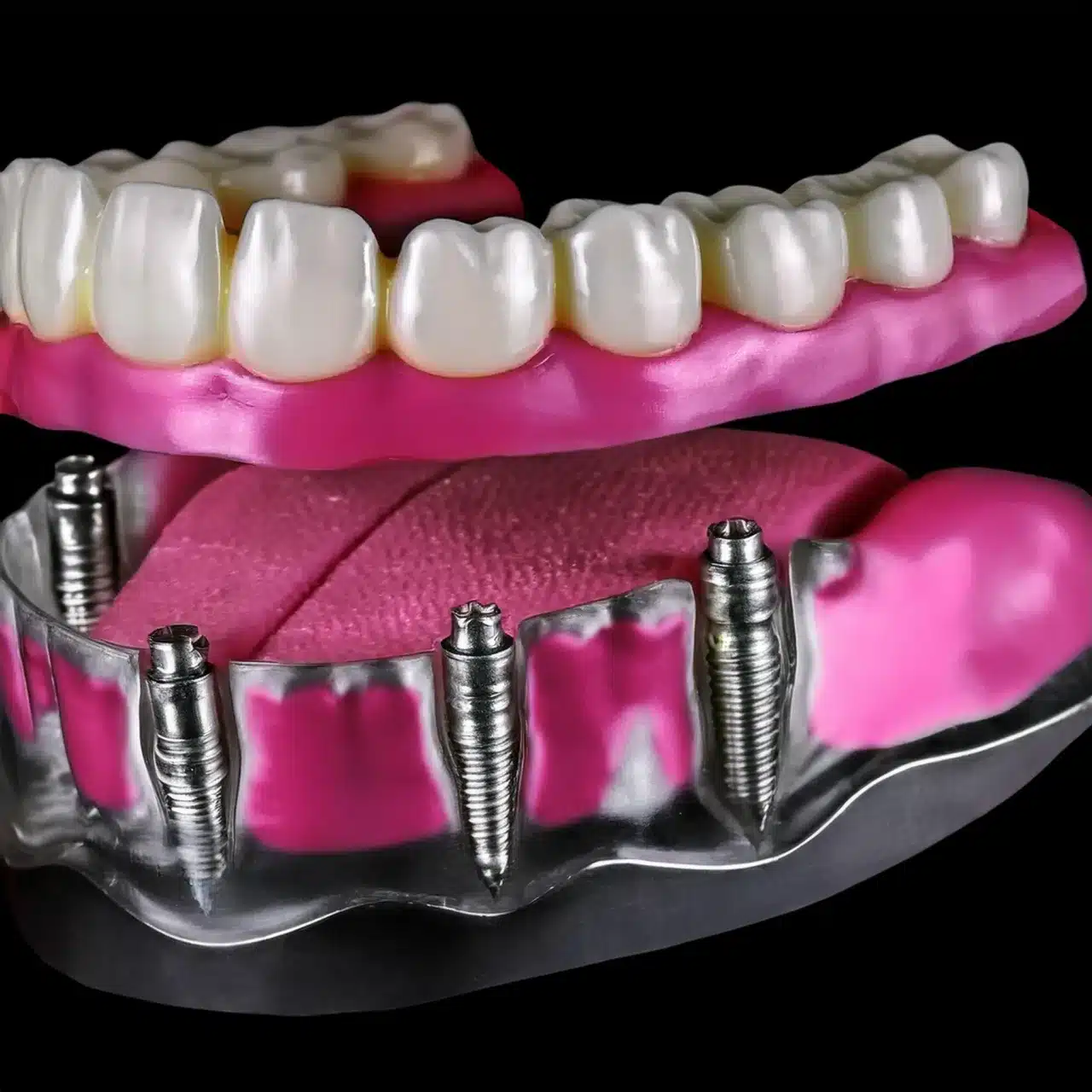 Implantes dentales All-on-8