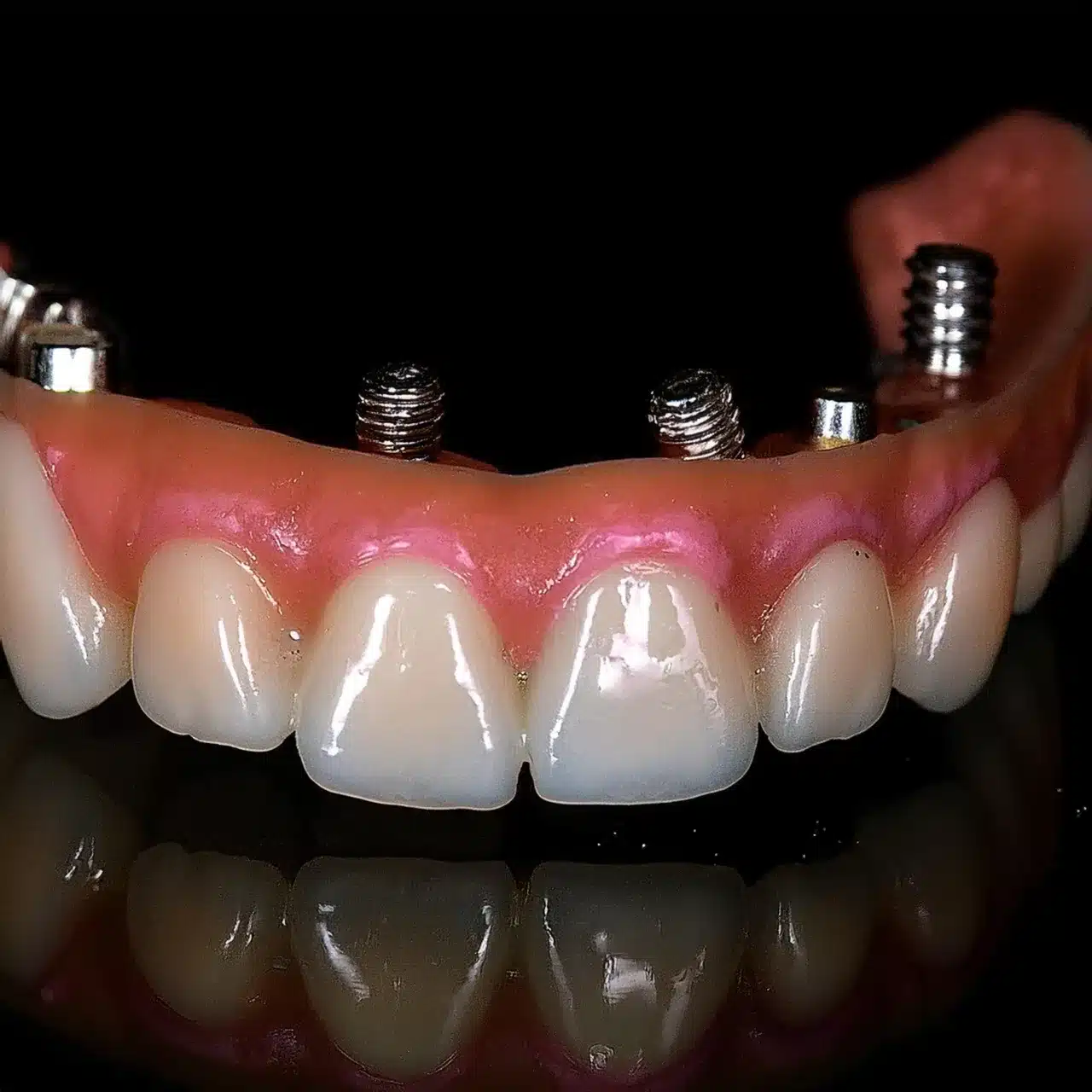 All-on-8 dental implants example