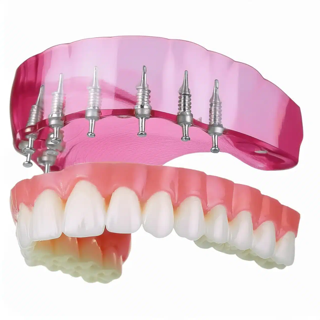 Impianti dentali All-on-8