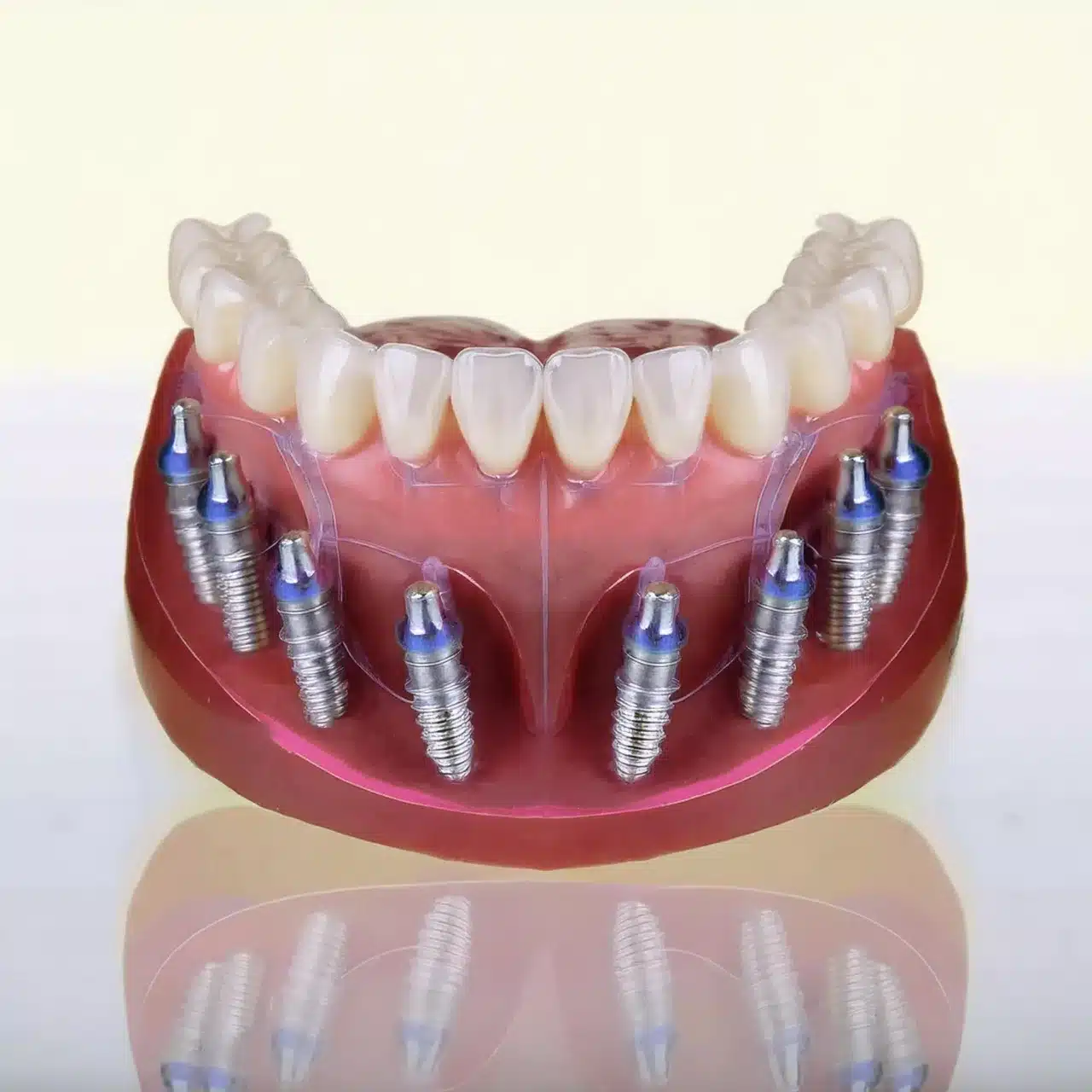 Tipos de implantes dentales All-on-8