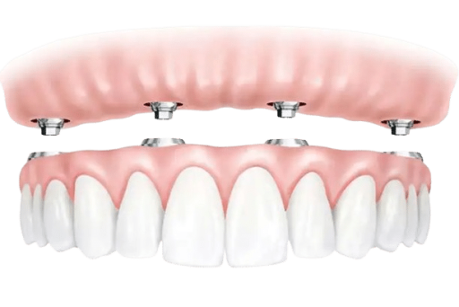 all_on_4_implants_resized_768x512-removebg-preview